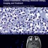 Oligodendroglioma_Clinical_Presentation_Pathology_Molecular_Biology_Imaging_and_Treatment.jpg