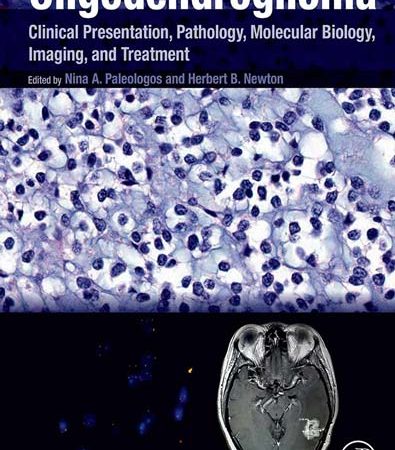 Oligodendroglioma_Clinical_Presentation_Pathology_Molecular_Biology_Imaging_and_Treatment.jpg